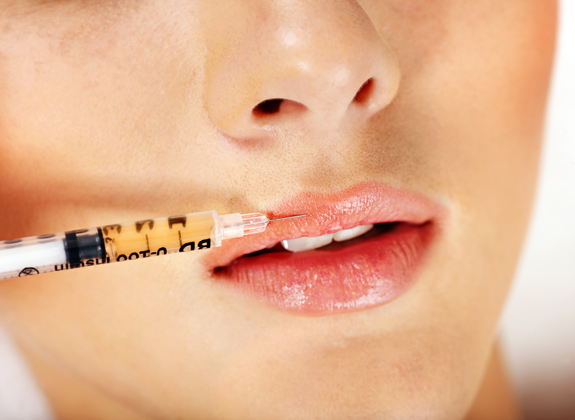 Kada je bilo prvo povećanje usana provedeno?